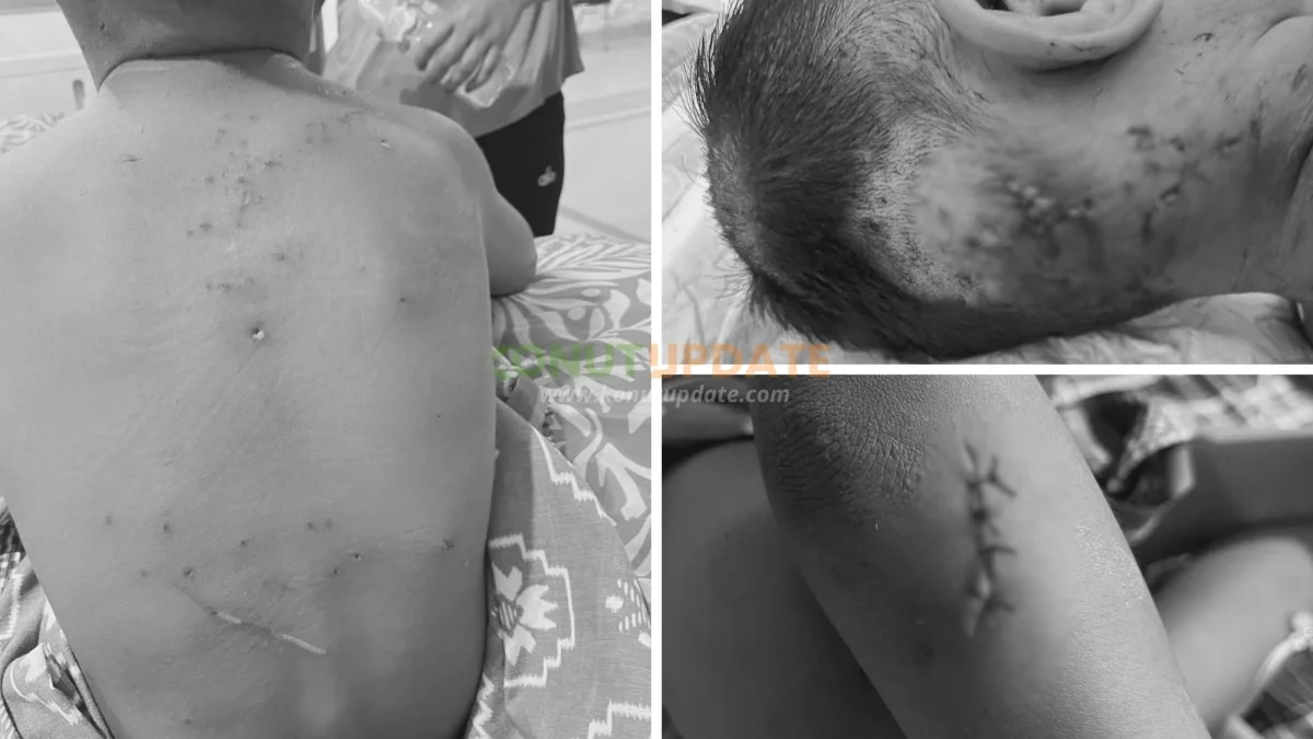 Bocah SD di Molawe Diduga Dianiaya Menggunakan Gunting, Alami Puluhan Luka